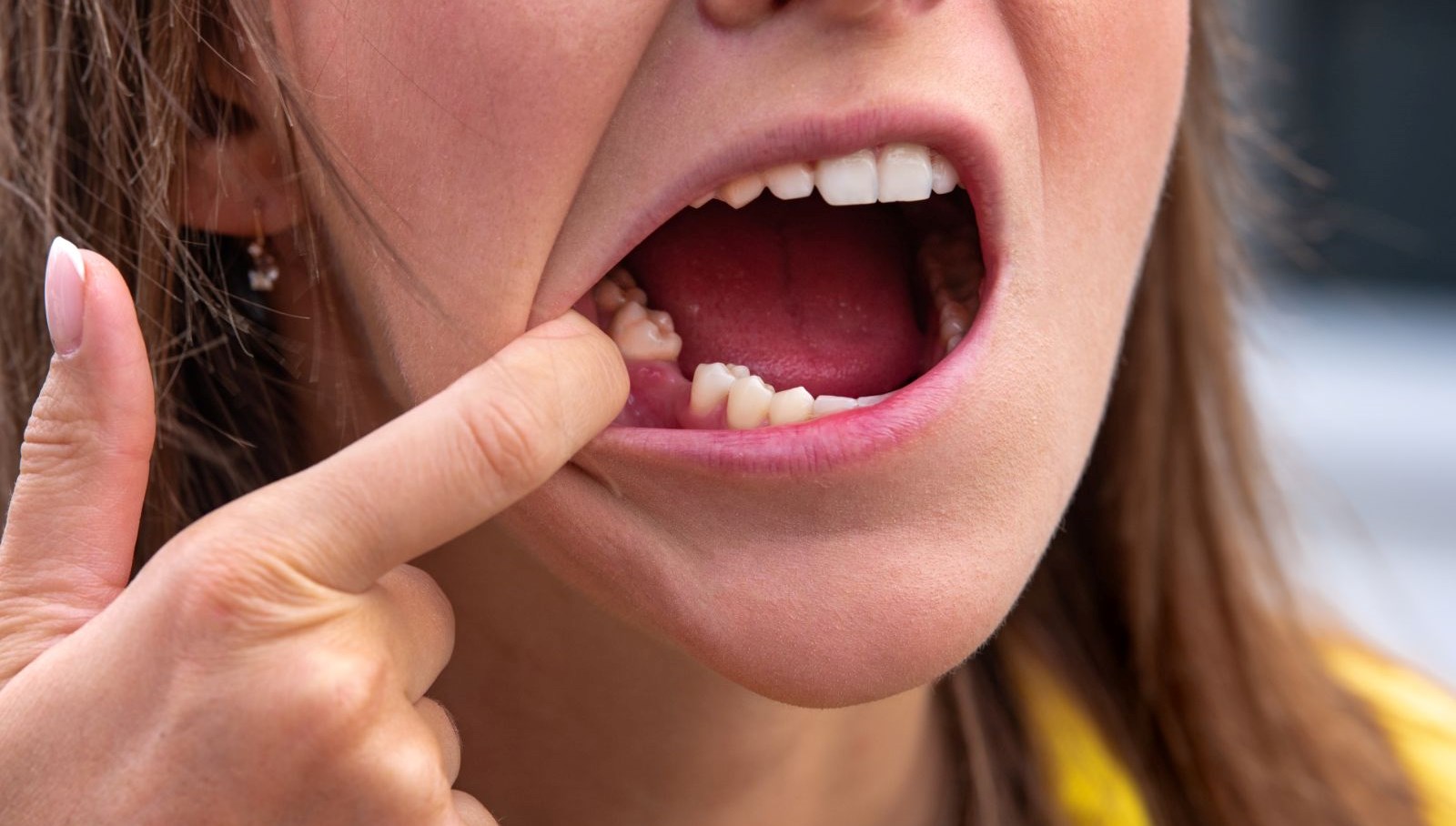 Japonya’da ilaç geliştiriliyor: Dişler yine çıkarılabilir